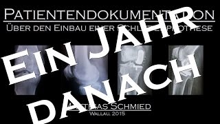 Patientendokumentation  Ein Jahr nach Einbau einer Schlittenprothese [upl. by Annayrb]