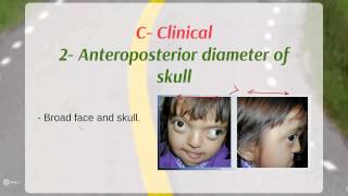 Crouzon syndrome  Definition  Etiology  Clinical [upl. by Eanaj]