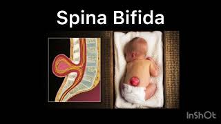 Dr You  Spina Bifda Types  reason dryou [upl. by Eilatam830]