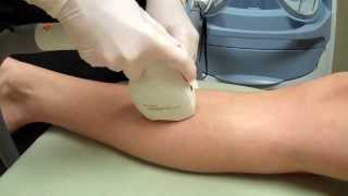 LightSheer Duet Laser Hair Removal on a Womans Legs [upl. by Elocel743]