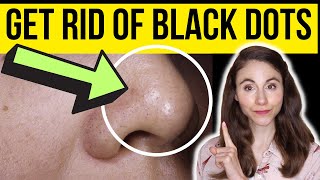 HOW TO GET RID OF BLACK DOTS ON THE NOSE  Dermatologist [upl. by Uda]