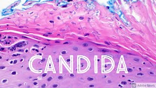 Candida Yeast Infection under microscope Candidiasis Dermatology Dermatopathology [upl. by Neeluj]