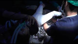 Technique of Hip Spica  Dr Abdul Latif Shahid  Pediatric Orthopedic Surgeon [upl. by Pauly589]