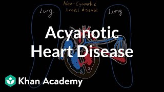 What is acyanotic heart disease  Circulatory System and Disease  NCLEXRN  Khan Academy [upl. by Valer]