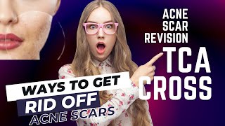 acne scar revision  tca cross  skeptre  tamil  rid of acne scars [upl. by Aninaig]