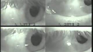 Horizontal Gaze Nystagmus Video [upl. by Ardnekal836]