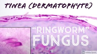 quotRingwormquot under the microscope It’s not a worm  it’s fungus tinea dermatophytosis pathology [upl. by Ettedranreb]