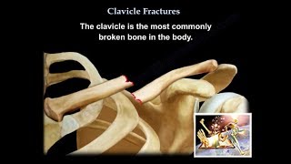 Clavicle Fractures  Everything You Need To Know  Dr Nabil Ebraheim [upl. by Thorny872]