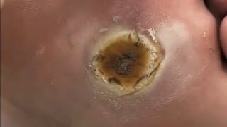 Pedicure video 41，vertical plantaris，plantar wartfeet [upl. by Ludeman]