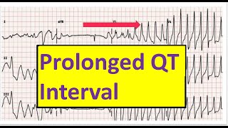 Prolonged QT interval Causes Measurements Torsades De Pointes [upl. by Crotty]