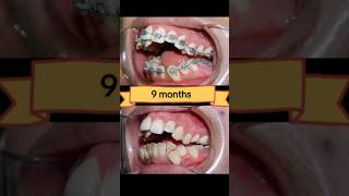 Braces Transformation [upl. by Ochs]