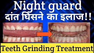 Night Guard For Teeth Grinding live Demo दांत घिसने का इलाज Bruxism Teeth Grinding Treatment [upl. by Brana]