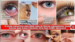 DRY EYE SYNDROME  हिंदी में  HINDI  Education amp Information Causes  Symptoms  Treatment [upl. by Novyad806]