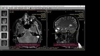 Orbital lymphangioma [upl. by Aniv]