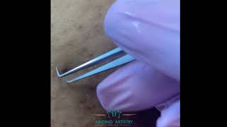 Ingrown Hair RemovalExtraction  Episode 6 [upl. by Franzoni129]