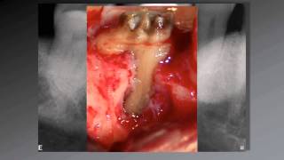 036 El uso de aumento en Endodoncia [upl. by Notyap]