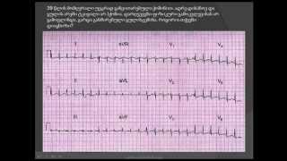 ეკგ  ფილტვის არტერიის თრომბოემბოლია ფილტვის არტერიის ემბოლია  filtvis arteriis tromboembolia [upl. by Netnerb]