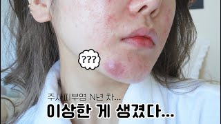 피부 근황🙄 요즘 피부를 위해 하는 노력들 더러움 주의 [upl. by Einahpad]