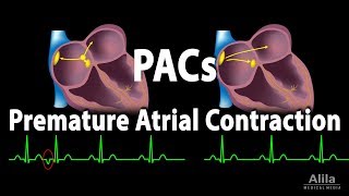 Premature Atrial Contractions PACs Animation [upl. by Ardnaik]