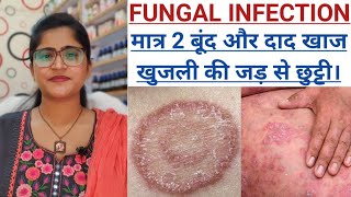 दाद खाज खुजली का जड़ से इलाज।।Fungus amp Tinea Treatment।।Ringworm Treatment।।khujli and daad ki dawa। [upl. by Fidelity]