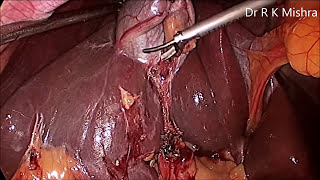 Gallbladder Stone Surgery [upl. by Florine]