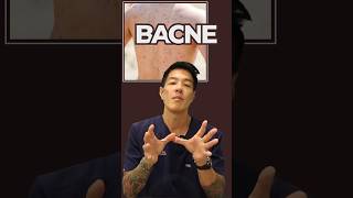 Treating Bacne  Dr Davin Lim [upl. by Edveh]