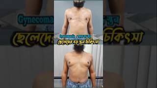 Gynecomastia Surgery cost [upl. by Siletotsira]