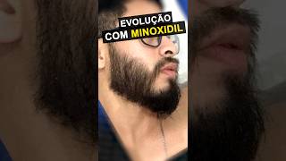 RESULTADO COM MINOXIDIL impressionante barba minoxidil [upl. by Aikkan174]