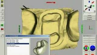 CEREC Crown Software [upl. by Ellord514]