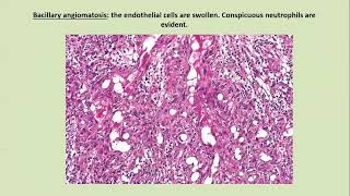 Lecture131 Brucellosis Bacilliary angiomatosis tropical ulcer Endemic syphilis Rook ch 26 [upl. by Ymiaj]