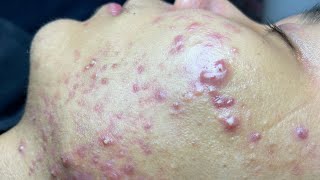 ACNE TREATMENT VU QUYNH MI Blackheads On Boy Face 2024 [upl. by Kelwin188]