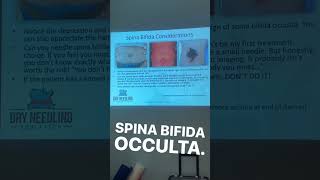 Spina Bifida Occulta In a class of six two sacral dimples [upl. by Mast]