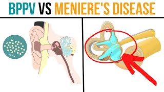 BPPV vs Menieres Disease Whats the Difference amp How to Improve [upl. by Latsyrhc]