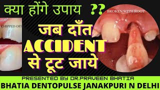 दाँत दुर्घटना से अगर टूट जाये तो क्या करें उपायDO IF TOOTH IS BROKEN BY ACCIDENTREMEDIESDRBHATIA [upl. by Enyale]