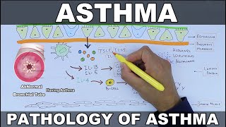 Asthma  Pathophysiology of Asthma [upl. by Nauh729]