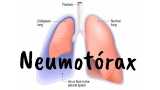 quotNeumotórax Causas Síntomas y Tratamiento Explicadosquot 🫁 [upl. by Nyladnohr]