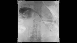 Enteroscopy overtube assisted over the wire stent placement to treat an enteral stenosis [upl. by Revell]