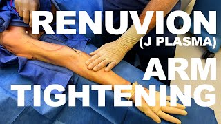 Renuvion JPlasma  Arm Tightening  Dr Paul Ruff  West End Plastic Surgery [upl. by Aloel162]