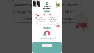 PULMONARY AMOEBIASIS parasitology microbiology pathology neet neetpg amoebiasis amoeba [upl. by Brawley834]