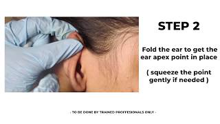 Blood letting Ear Apex  How to do  Ear Apex  Auricular Acupuncture Therapy [upl. by Darrej]