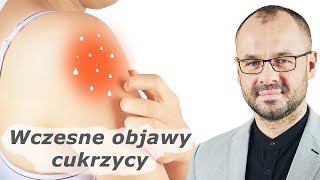 Nie ignoruj ​​tych 10 wczesnych objawów cukrzycy [upl. by Polivy485]