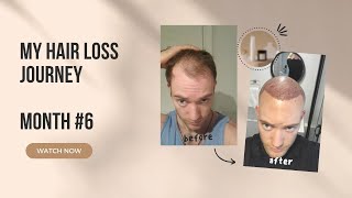 Month 6 Hair transplant RESULTS HLC Clinic Before amp After at the end [upl. by Otsenre]