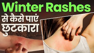 How To Get Rid Of Winter Rashes I सर्दी के चकत्तों से कैसे पाएं छुटकारा I Skin Care [upl. by Anorahs432]