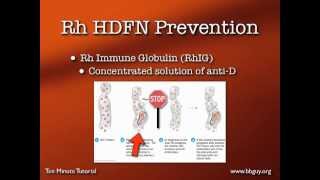 Dosing Rh Immune Globulin [upl. by Lawton431]