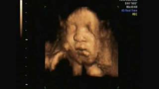 7 month 4D ultrasound [upl. by Leirda]