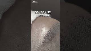 How Hair Transplant Works  Hair Transplant Timelapse [upl. by Ojok843]