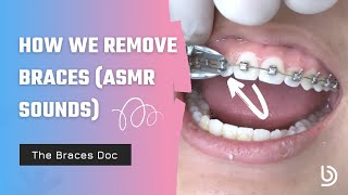 Satisfying Braces Removal w The Braces Doc ASMR — How we remove braces [upl. by Tayib]