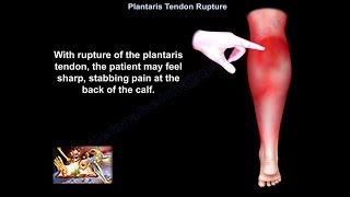 Plantaris Muscle Pain  Plantaris Rupture and Plantaris Tendonitis [upl. by Plumbo]