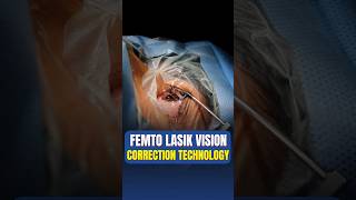 Live Femto Lasik Vision Correction Surgery [upl. by Stormi939]