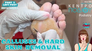 Part 3 Calluses amp Hard Skin Removal feet κεντροποδιου foot podologos podiatrist corn footcare [upl. by Ondrea]